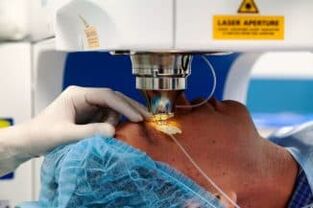 Chirurgie de la vision laser